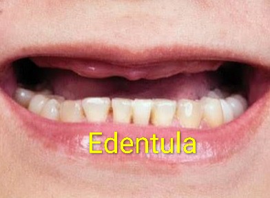 Edentula 
